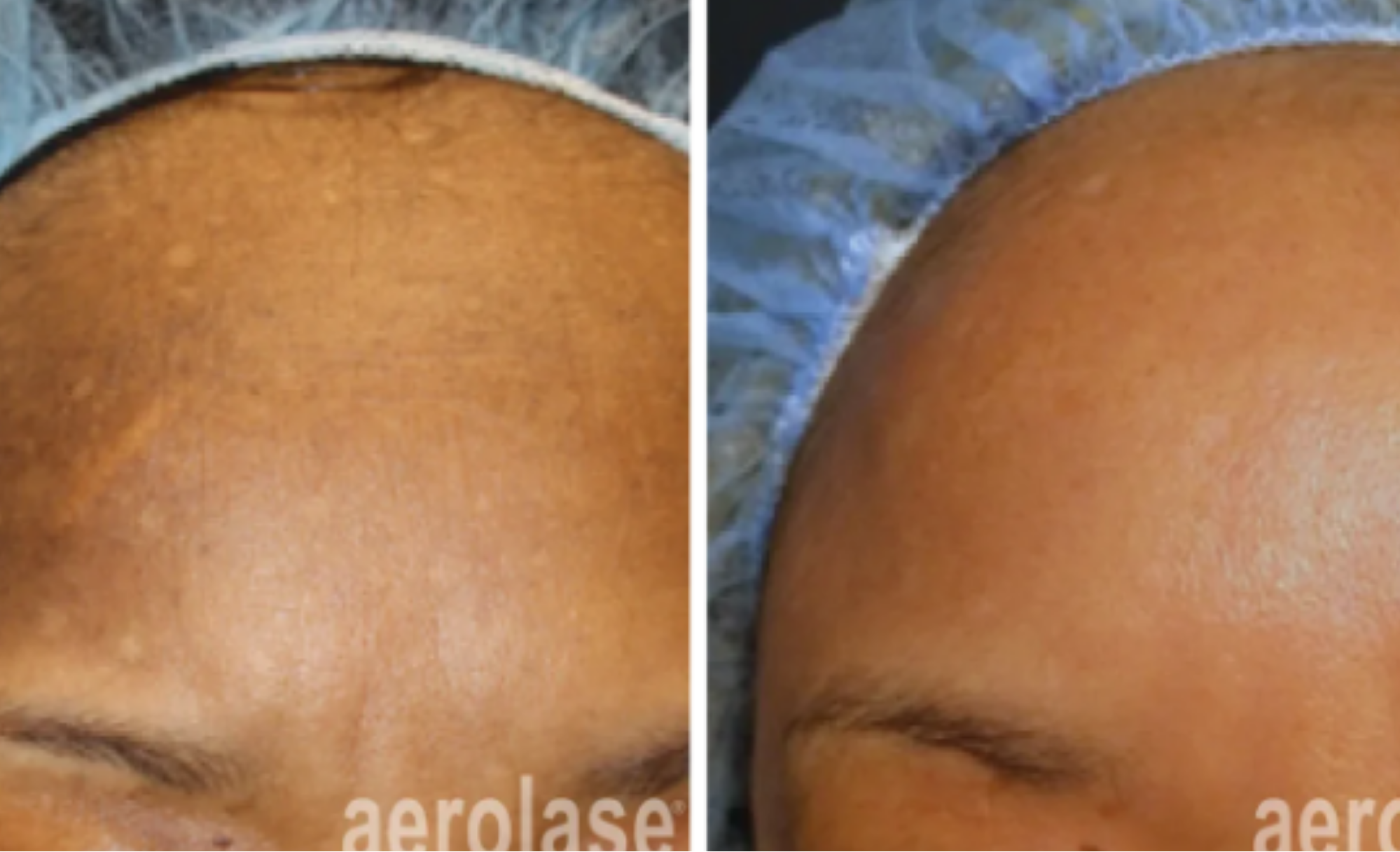 June Special: The Aerolase Skin Makeover