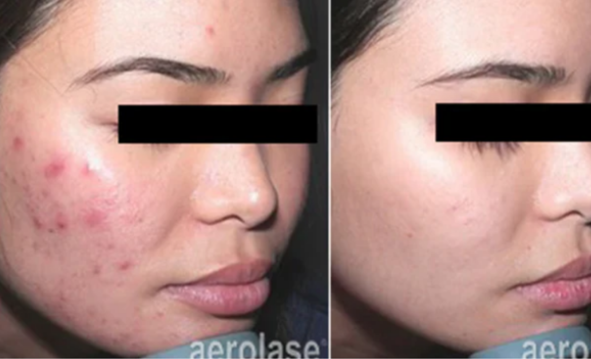 June Special: The Aerolase Skin Makeover