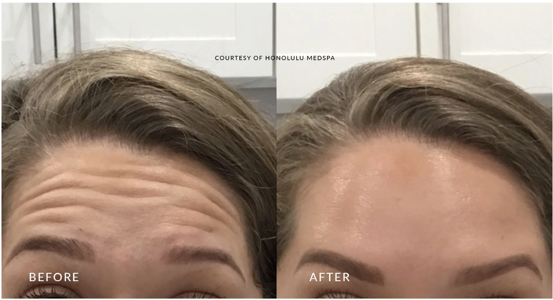 Botox Save SAVE $50 OFF BOTOX!