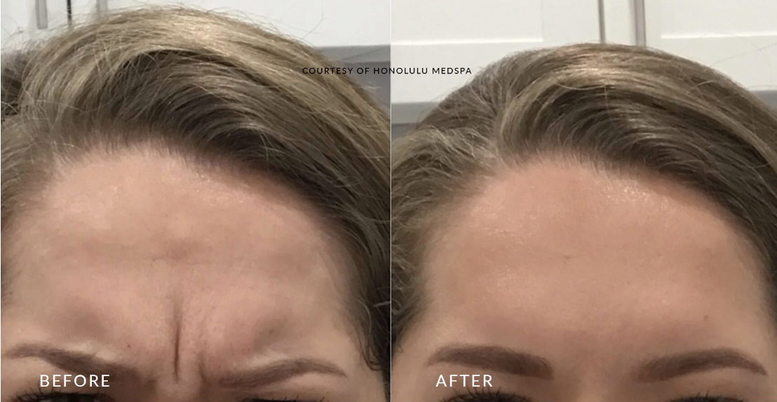 SAVE $50 OFF BOTOX!