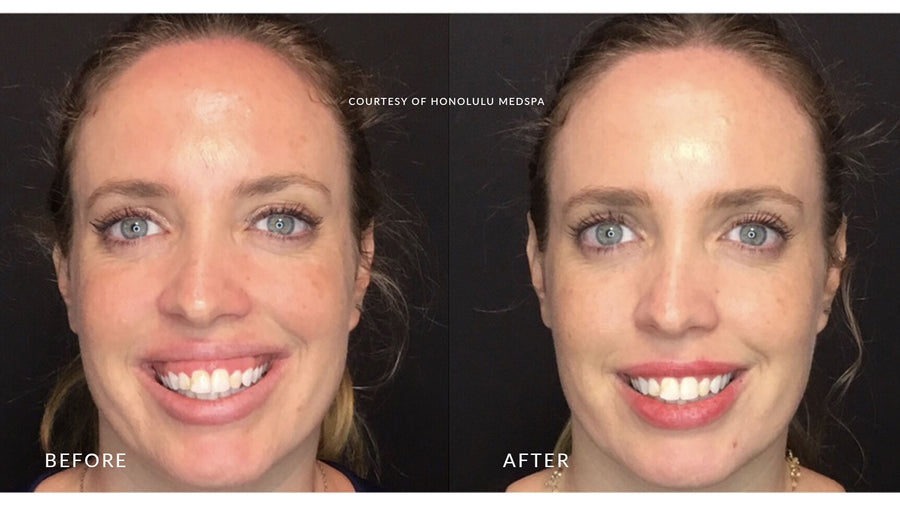 BOTOX® FOR FINE LINES AND WRINKLES - Honolulu MedSpa