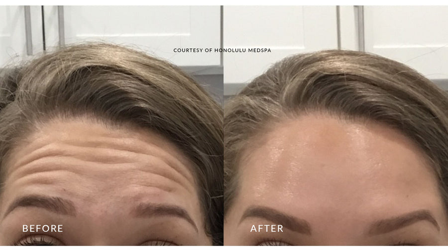 BOTOX® FOR FINE LINES AND WRINKLES - Honolulu MedSpa