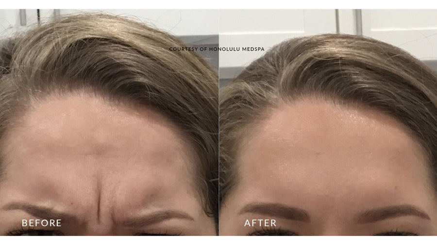 BOTOX® FOR FINE LINES AND WRINKLES - Honolulu MedSpa