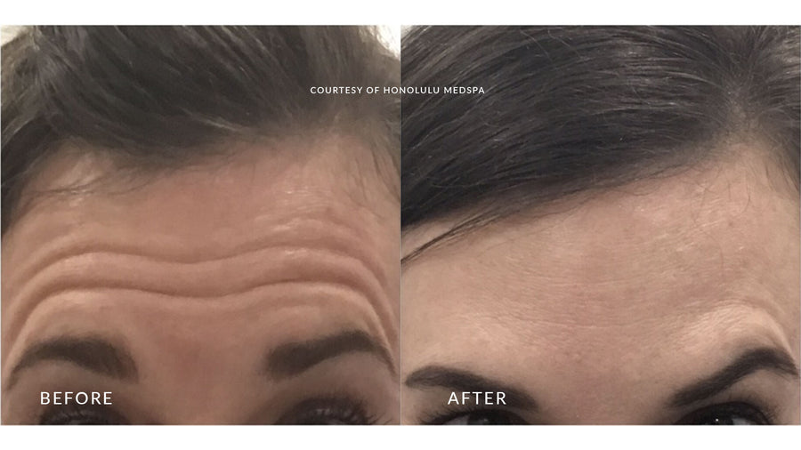 BOTOX® FOR FINE LINES AND WRINKLES - Honolulu MedSpa