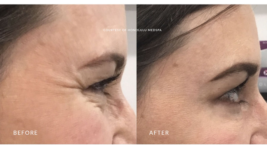 BOTOX® FOR FINE LINES AND WRINKLES - Honolulu MedSpa