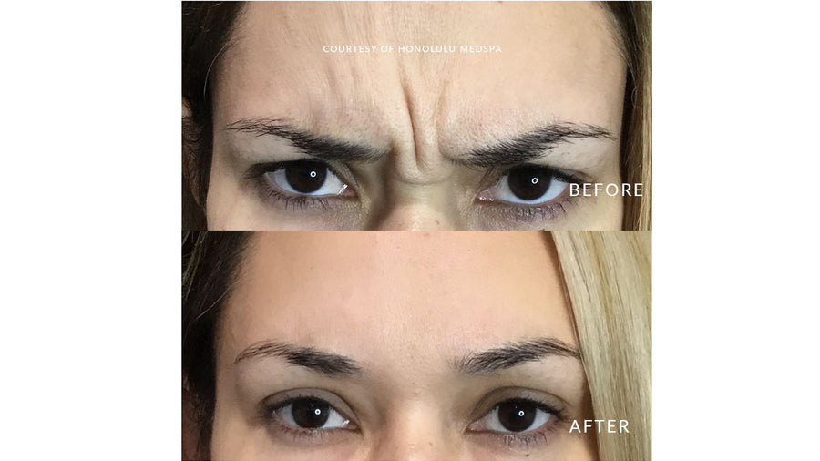 BOTOX® FOR FINE LINES AND WRINKLES - Honolulu MedSpa