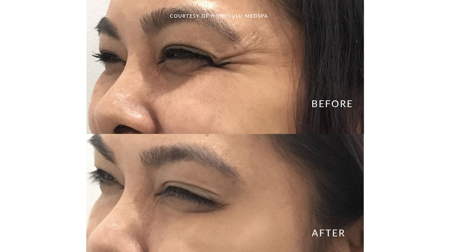 BOTOX® FOR FINE LINES AND WRINKLES - Honolulu MedSpa