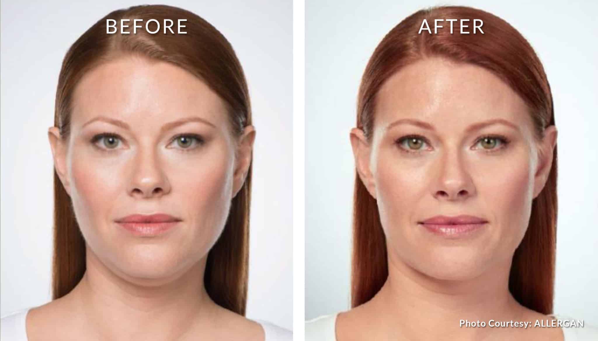 KYBELLA® for double chin KYBELLA® for double chin